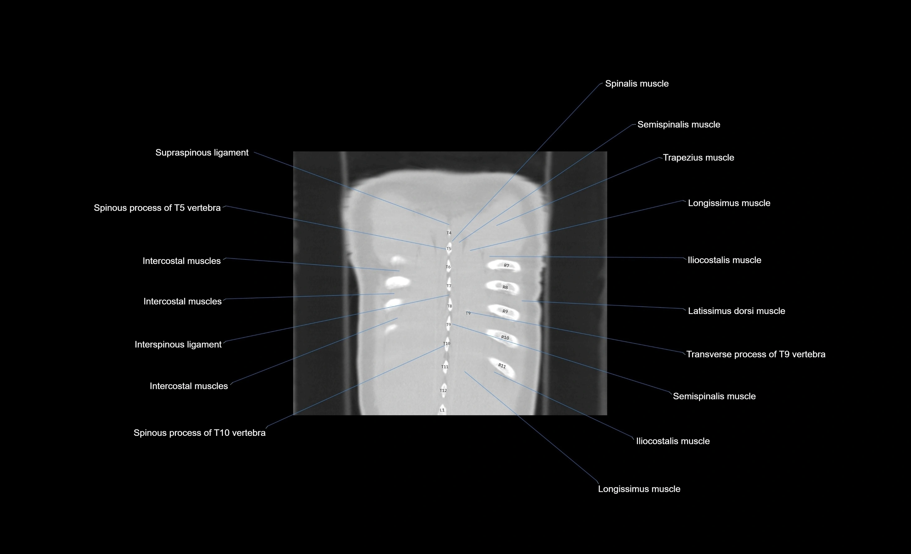 CT chest (thorax) lung window window labelled coronal cross sectional anatomy radiology image-00012.webp
